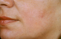 После курса лечения Glycolic Acid Gel 50% + Kojic Acid and Phytic Acid