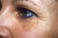 После курса лечения Glycolic Acid Gel 70%